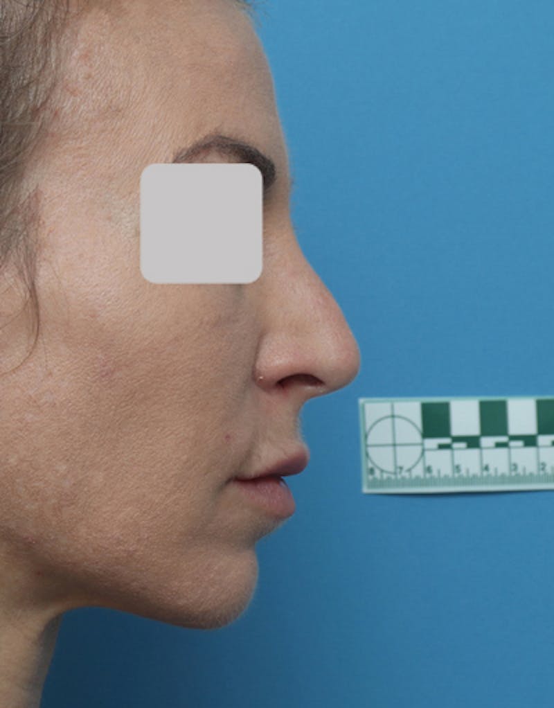 Revision Rhinoplasty Before & After Gallery - Patient 678090 - Image 1