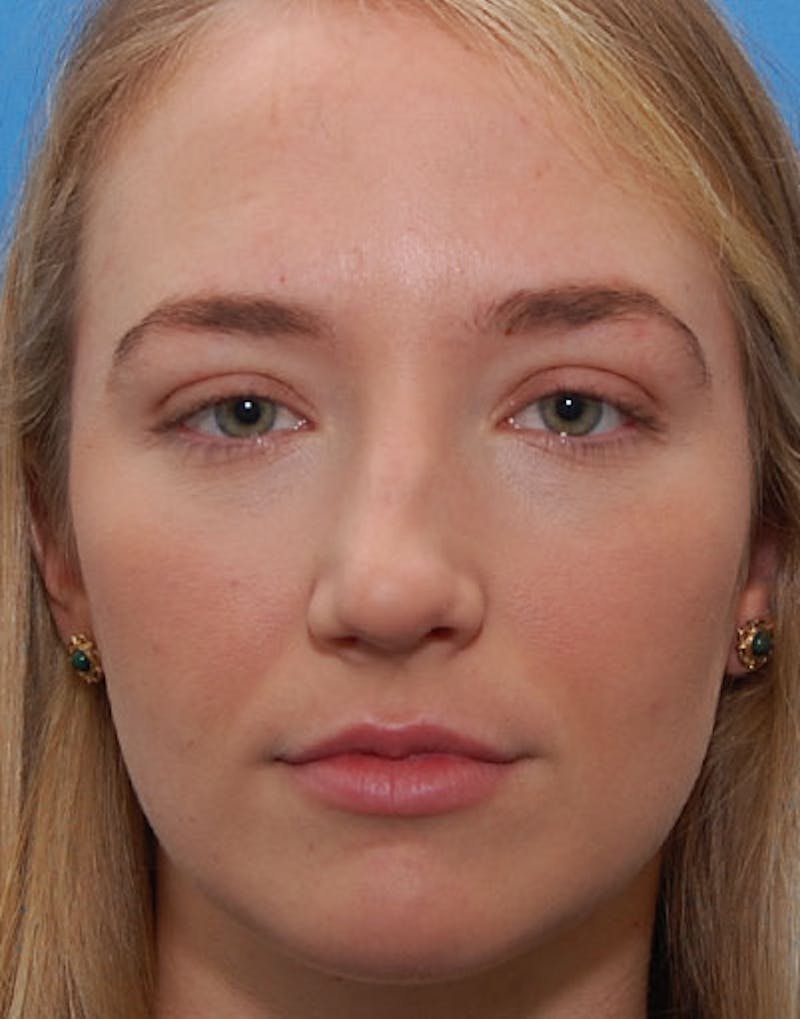 Foundation Rhinoplasty / Crooked Nose Before & After Gallery - Patient 145373 - Image 1