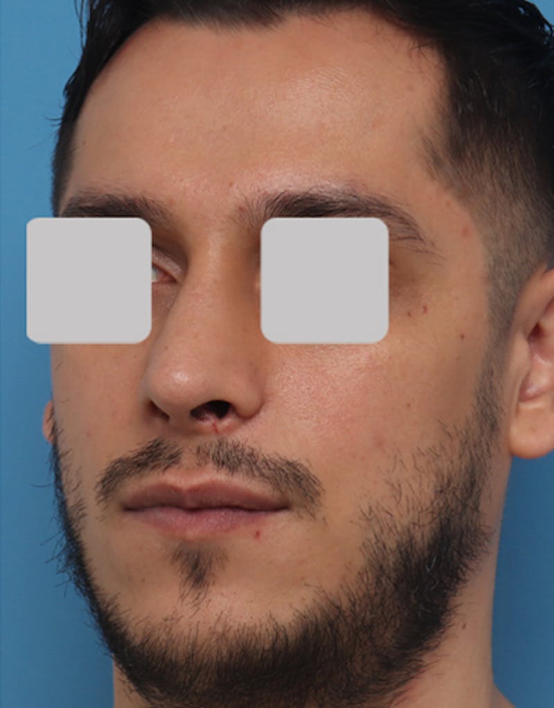 Male Rhinoplasty Before & After Gallery - Patient 251996 - Image 4