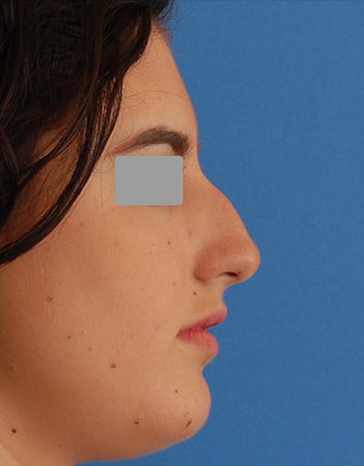 Rhinoplasty Before & After Gallery - Patient 401162 - Image 1