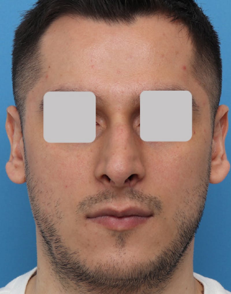 Male Rhinoplasty Before & After Gallery - Patient 251996 - Image 5