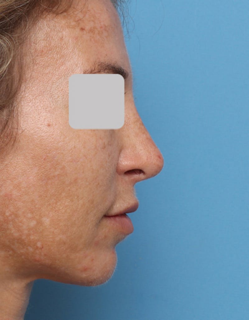 Revision Rhinoplasty Before & After Gallery - Patient 678090 - Image 2