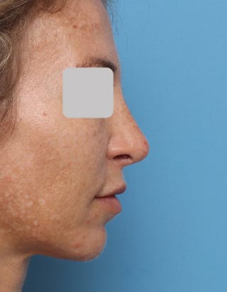 Rhinoplasty Before & After Gallery - Patient 162347 - Image 2