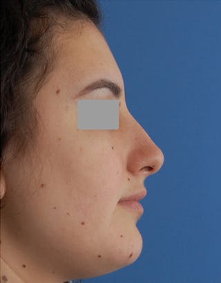 Rhinoplasty Before & After Gallery - Patient 401162 - Image 2