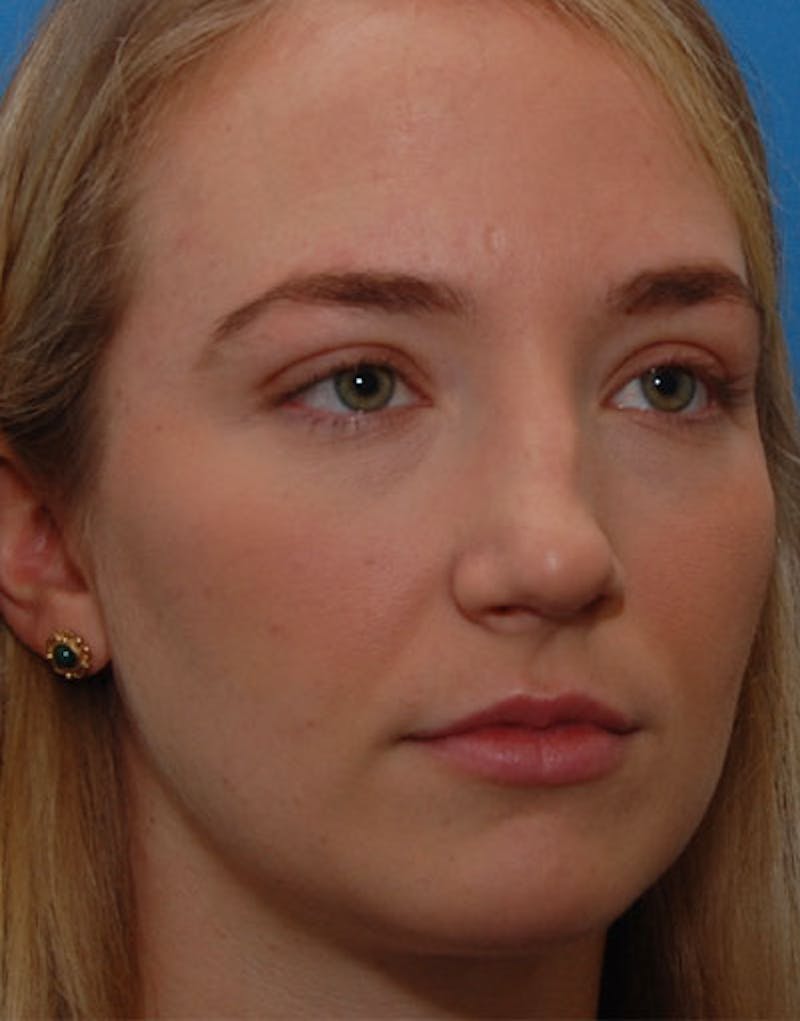 Foundation Rhinoplasty / Crooked Nose Before & After Gallery - Patient 145373 - Image 4