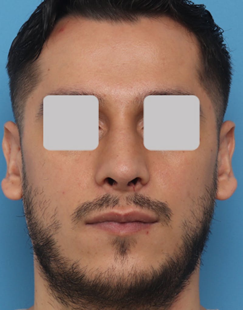 Male Rhinoplasty Before & After Gallery - Patient 251996 - Image 6