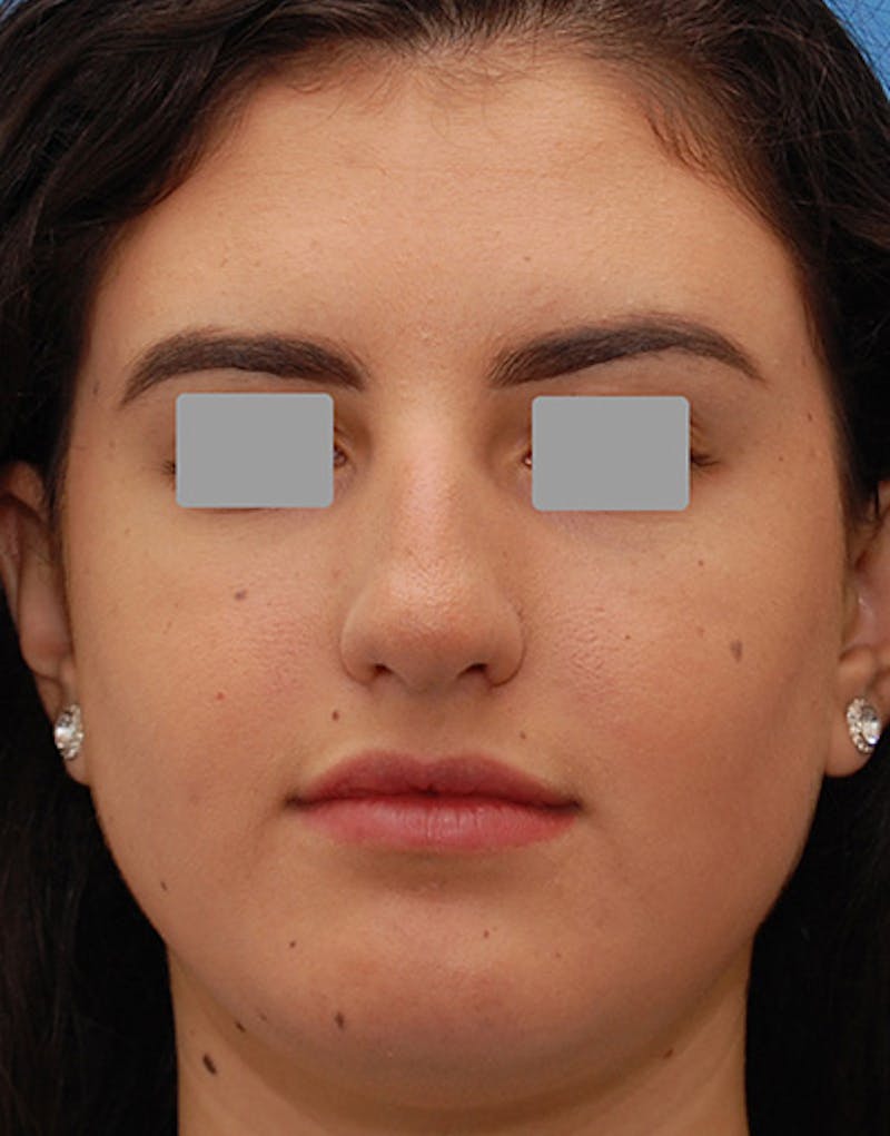 Rhinoplasty  Before & After Gallery - Patient 401162 - Image 3