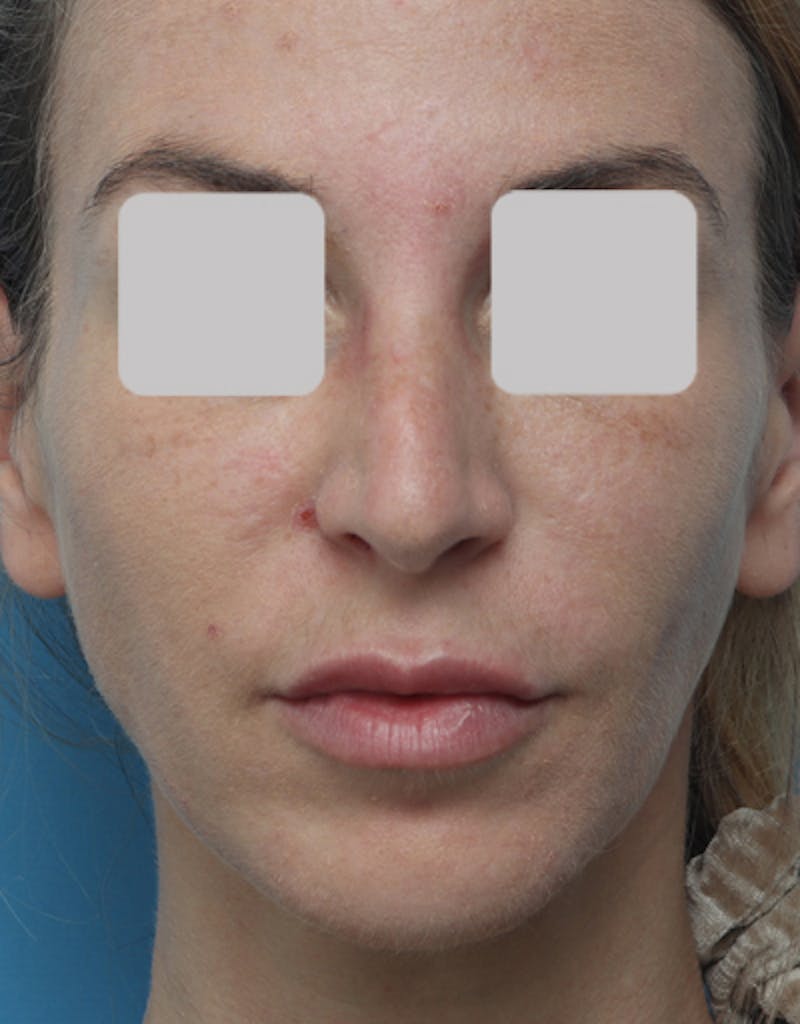 Revision Rhinoplasty Before & After Gallery - Patient 678090 - Image 3