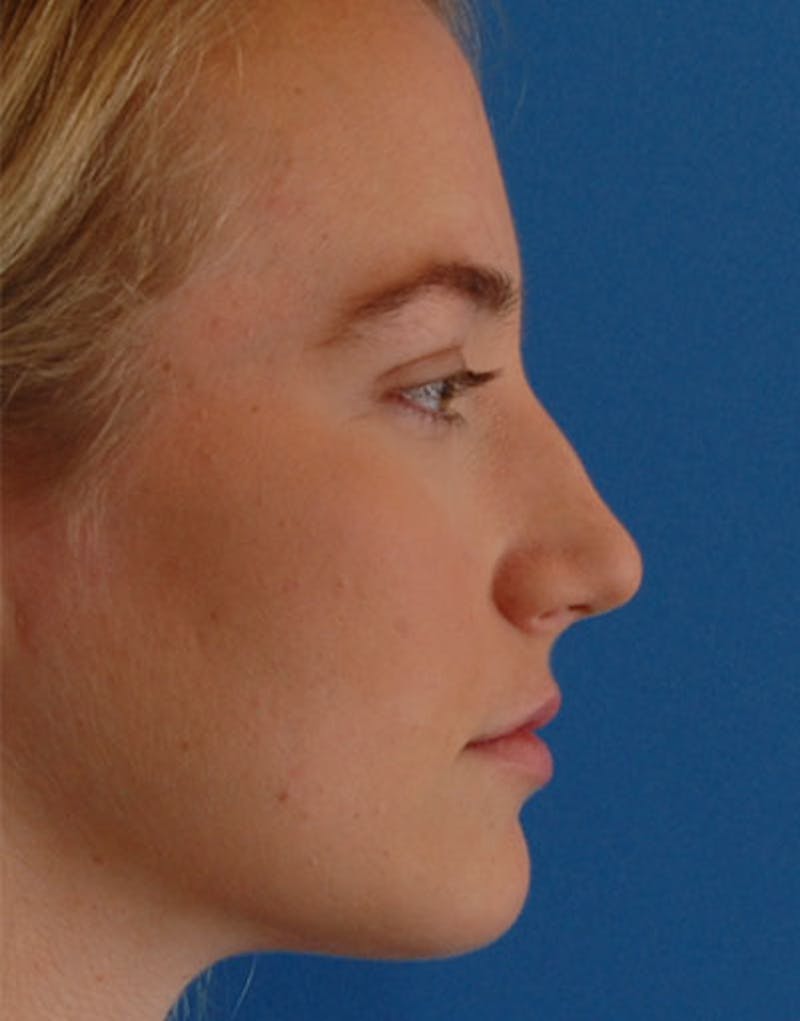 Foundation Rhinoplasty / Crooked Nose Before & After Gallery - Patient 145373 - Image 5