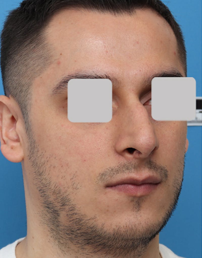 Male Rhinoplasty Before & After Gallery - Patient 251996 - Image 7