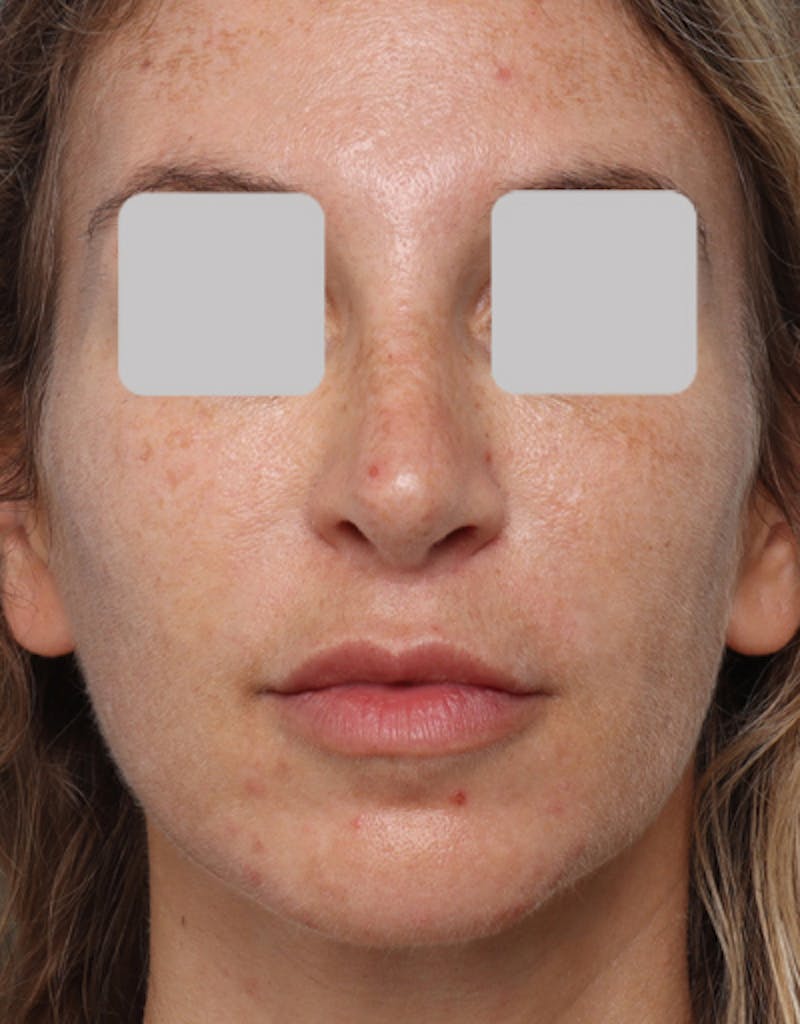 Revision Rhinoplasty Before & After Gallery - Patient 678090 - Image 4