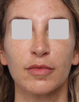 Rhinoplasty Before & After Gallery - Patient 162347 - Image 4