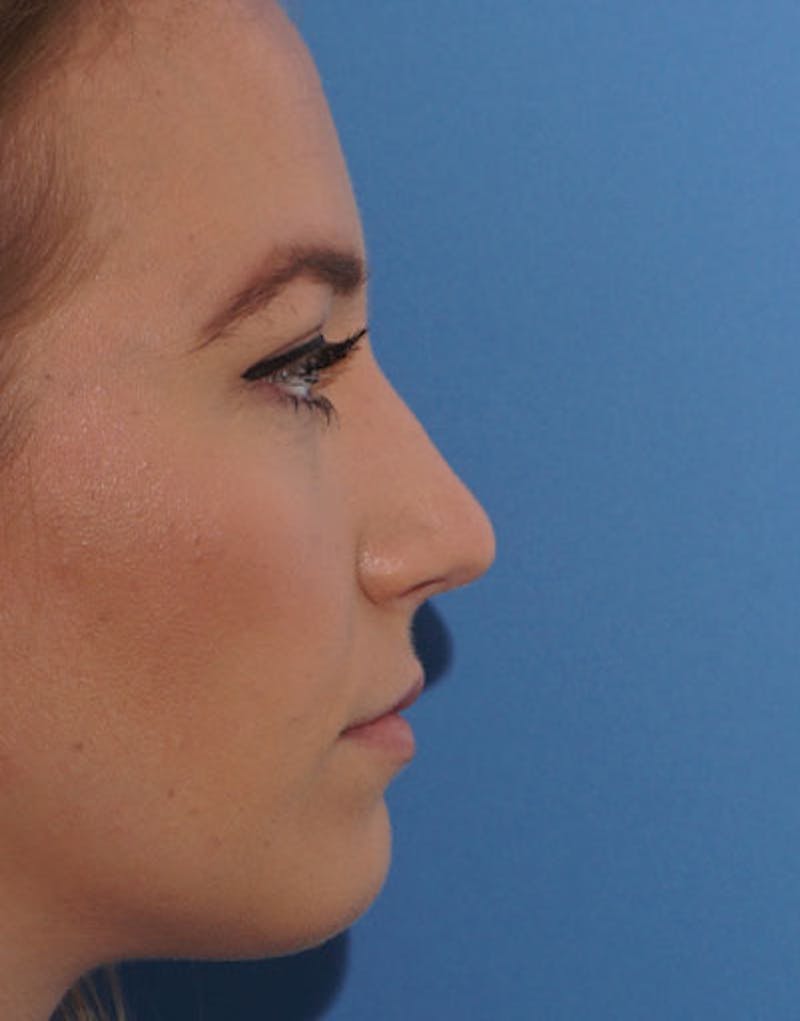 Foundation Rhinoplasty / Crooked Nose Before & After Gallery - Patient 145373 - Image 6