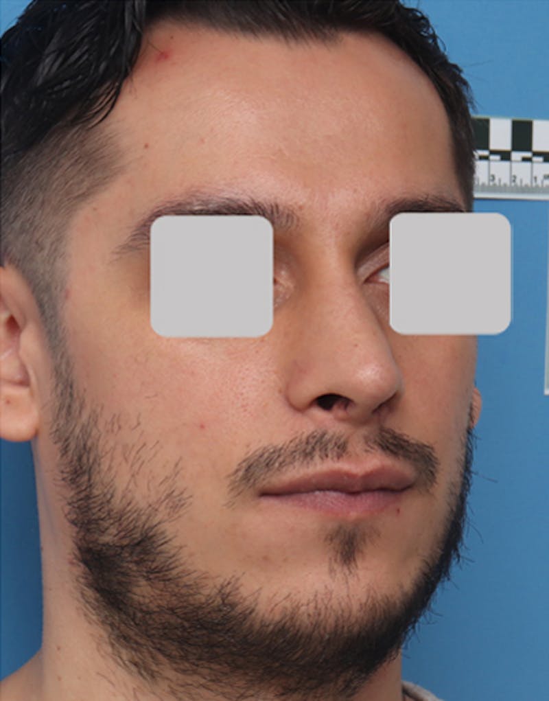 Male Rhinoplasty Before & After Gallery - Patient 251996 - Image 8