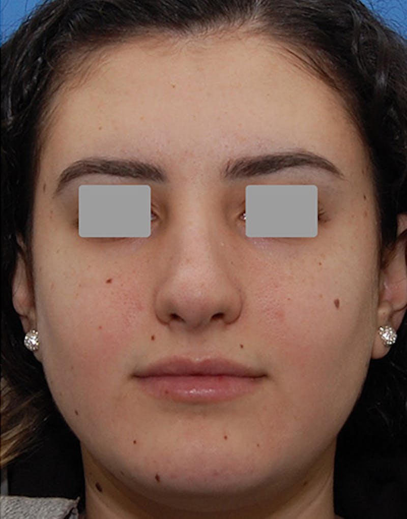 Rhinoplasty  Before & After Gallery - Patient 401162 - Image 4