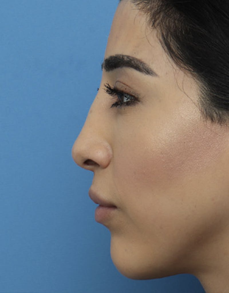 Revision Rhinoplasty Before & After Gallery - Patient 302240 - Image 1