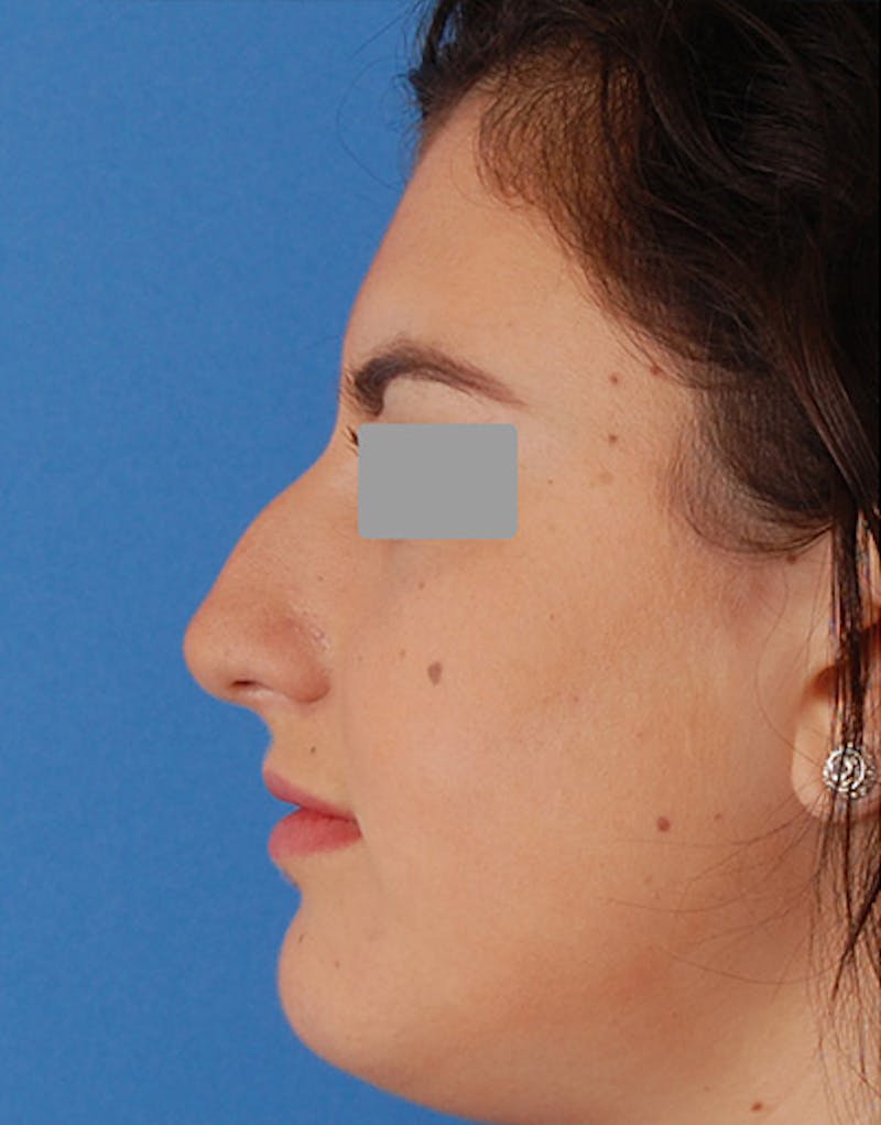 Rhinoplasty  Before & After Gallery - Patient 401162 - Image 5