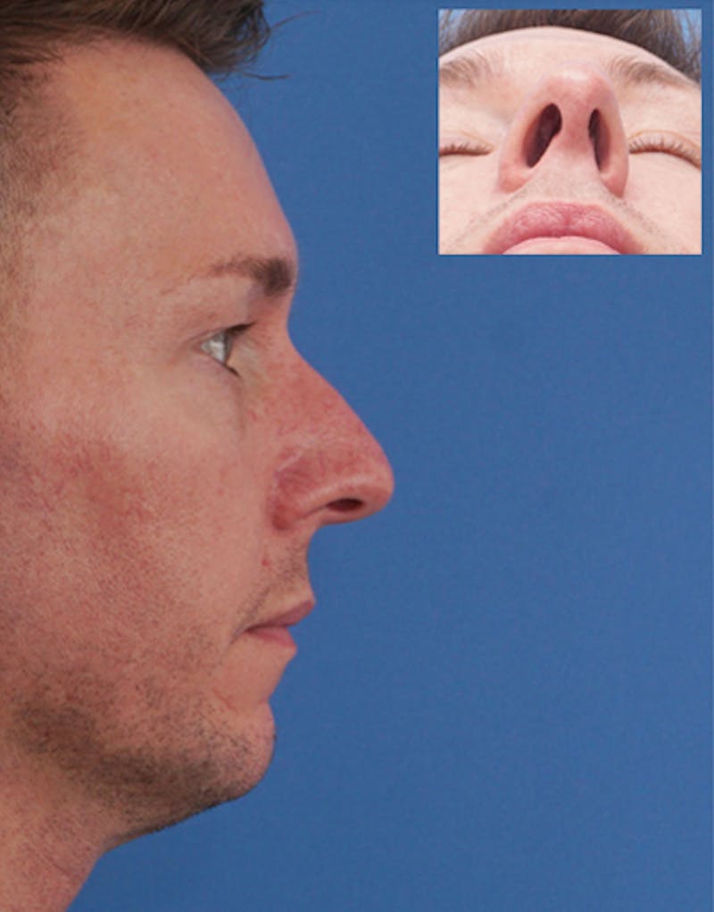 Male Rhinoplasty Before & After Gallery - Patient 117178 - Image 1