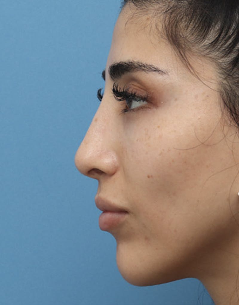 Revision Rhinoplasty Before & After Gallery - Patient 302240 - Image 2