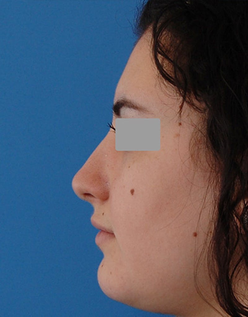 Rhinoplasty  Before & After Gallery - Patient 401162 - Image 6