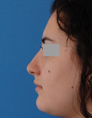 Rhinoplasty Before & After Gallery - Patient 401162 - Image 6