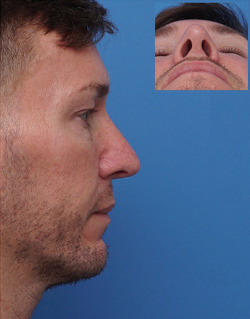 Male Rhinoplasty Before & After Gallery - Patient 117178 - Image 2
