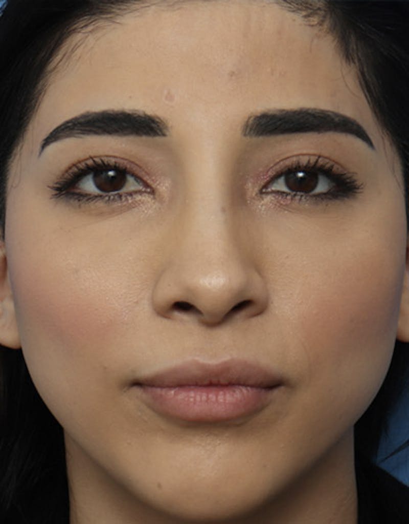 Revision Rhinoplasty Before & After Gallery - Patient 302240 - Image 3
