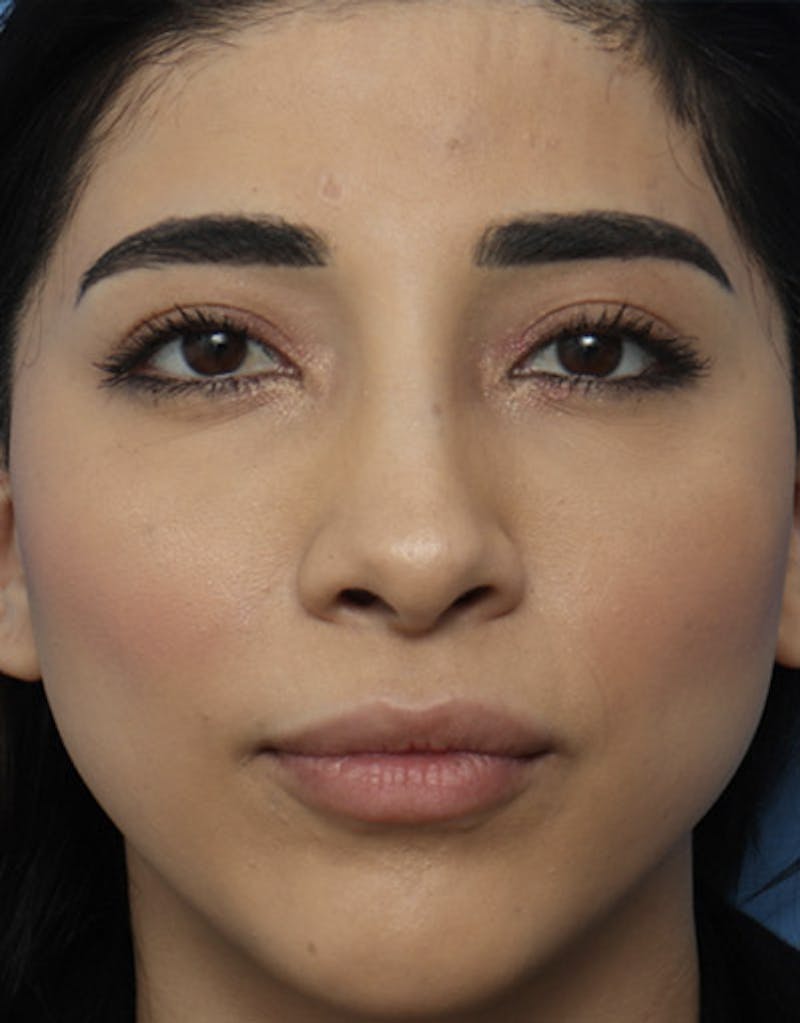 Rhinoplasty  Before & After Gallery - Patient 232650 - Image 3