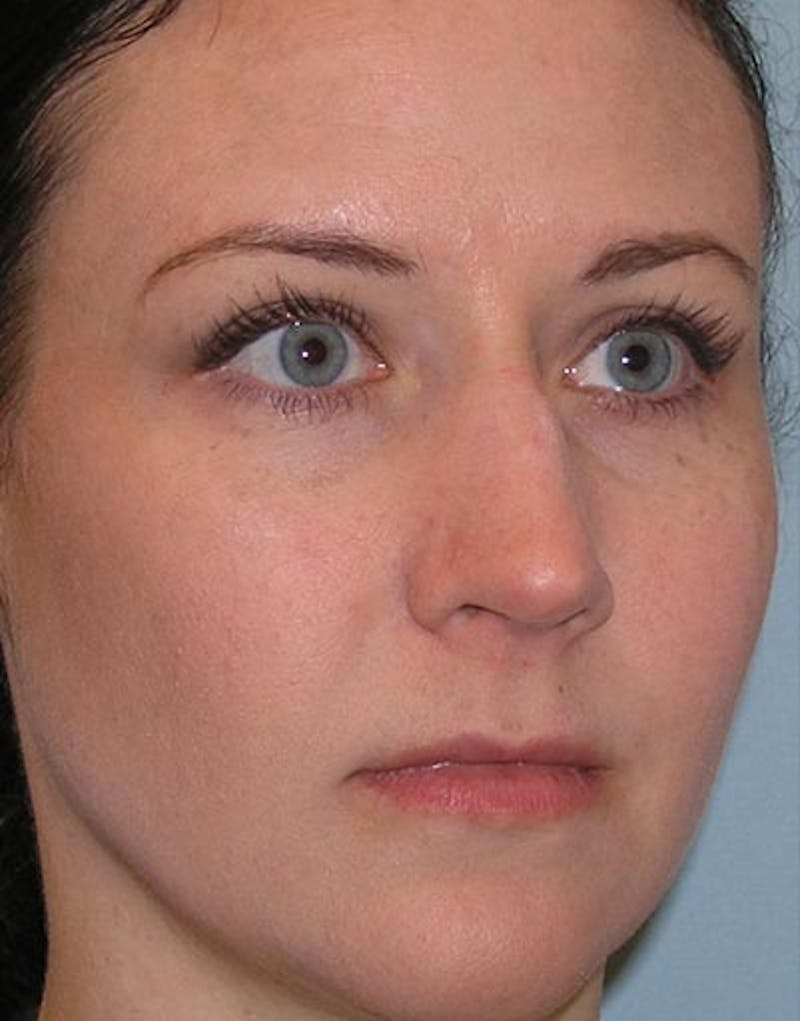 Rhinoplasty Before & After Gallery - Patient 209073 - Image 7