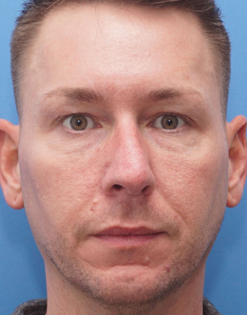 Favorite Male Rhinoplasty Before & After Gallery - Patient 409461 - Image 3