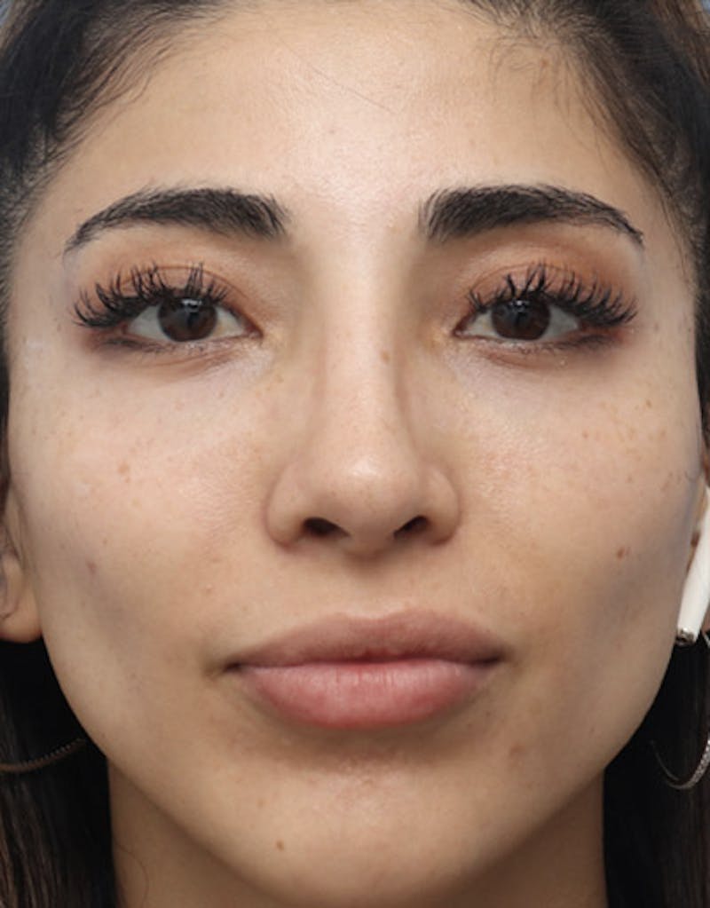 Revision Rhinoplasty Before & After Gallery - Patient 302240 - Image 4