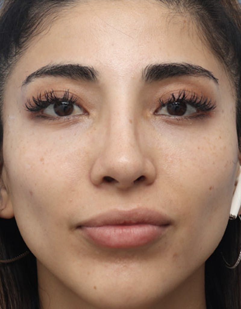 Rhinoplasty  Before & After Gallery - Patient 232650 - Image 4