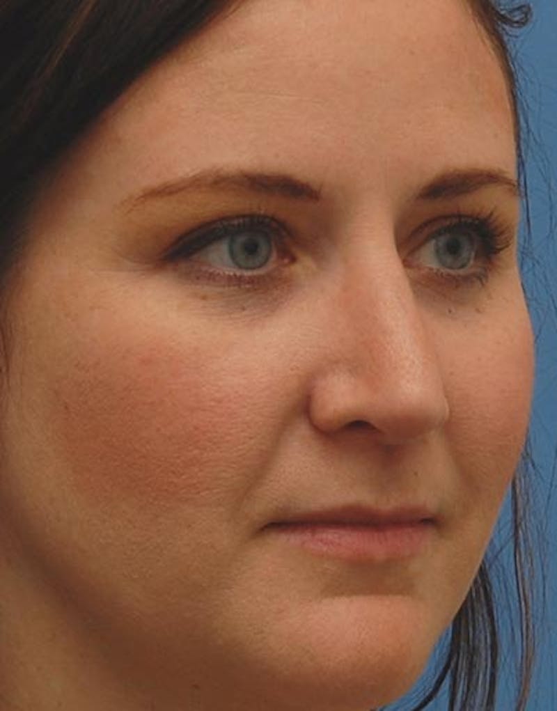 Rhinoplasty Before & After Gallery - Patient 209073 - Image 8