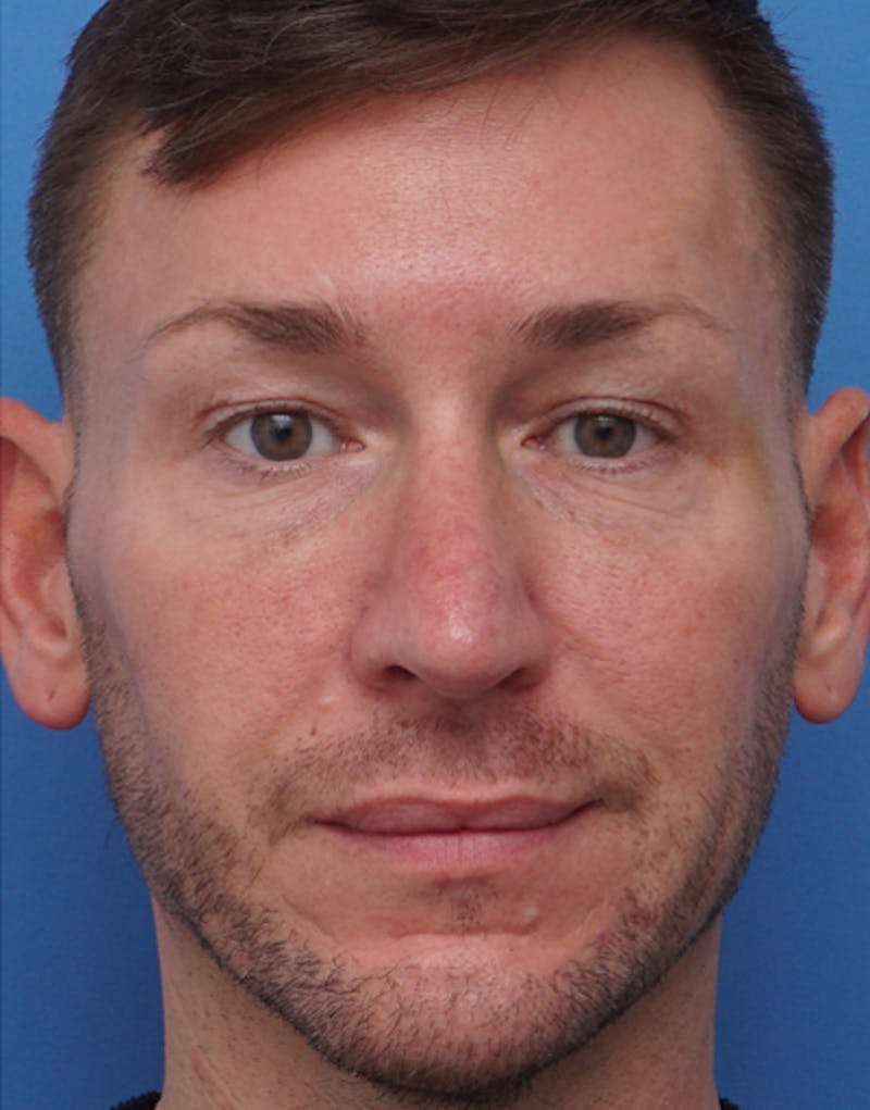 Male Rhinoplasty Before & After Gallery - Patient 117178 - Image 4
