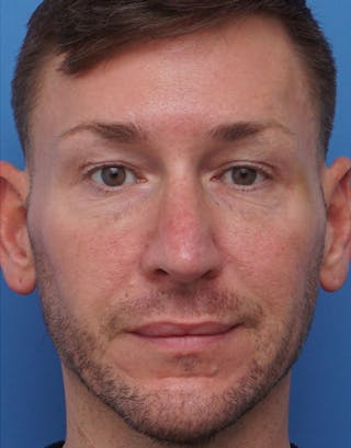 Favorite Male Rhinoplasty Before & After Gallery - Patient 409461 - Image 4