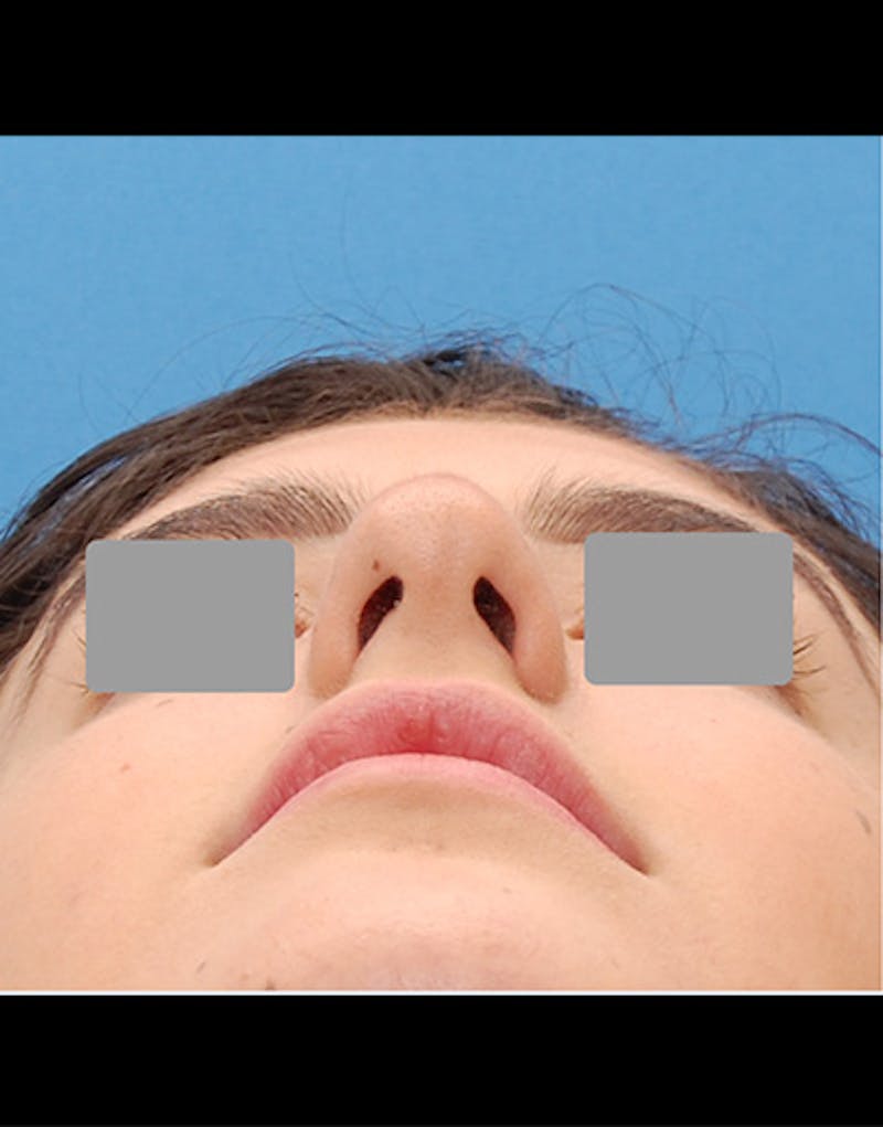 Rhinoplasty Before & After Gallery - Patient 209073 - Image 9