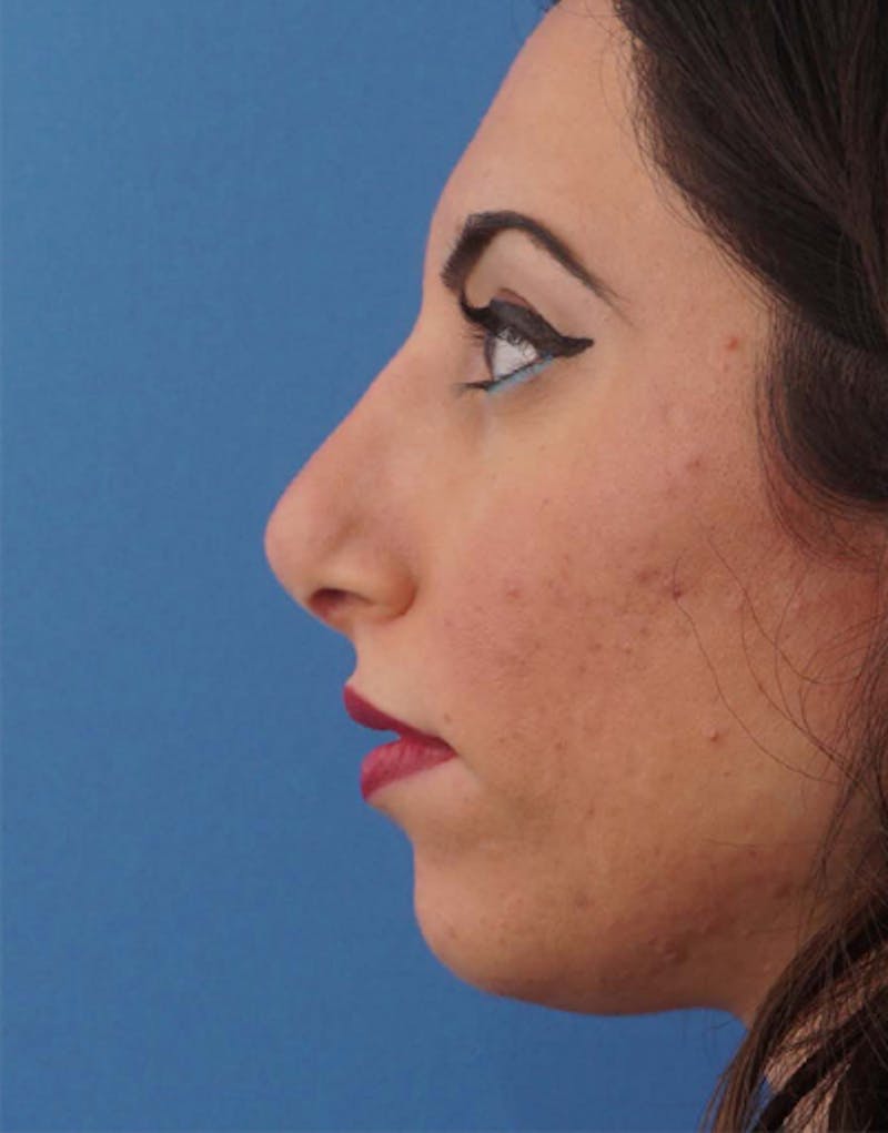 Revision Rhinoplasty Before & After Gallery - Patient 310051 - Image 1