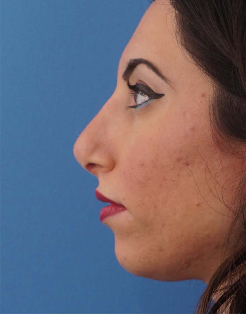 Favorite Revision Rhinoplasty Before & After Gallery - Patient 155140 - Image 9