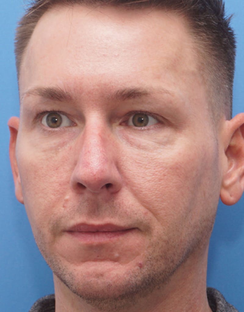 Favorite Male Rhinoplasty Before & After Gallery - Patient 409461 - Image 5
