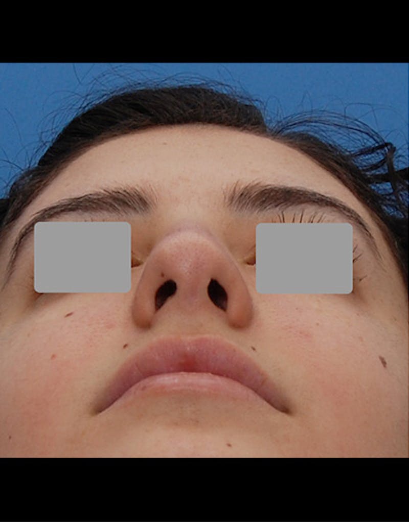 Rhinoplasty  Before & After Gallery - Patient 401162 - Image 8