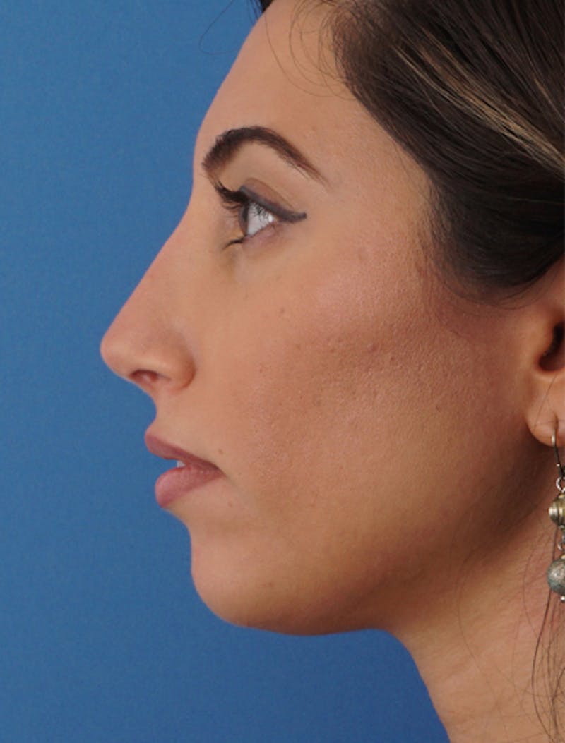 Revision Rhinoplasty Before & After Gallery - Patient 310051 - Image 2