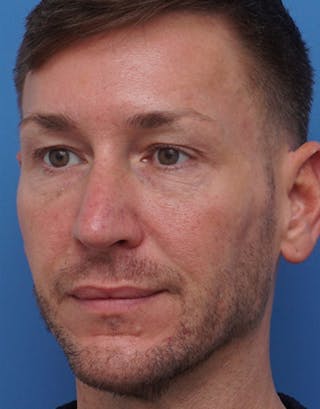 Favorite Male Rhinoplasty Before & After Gallery - Patient 409461 - Image 6