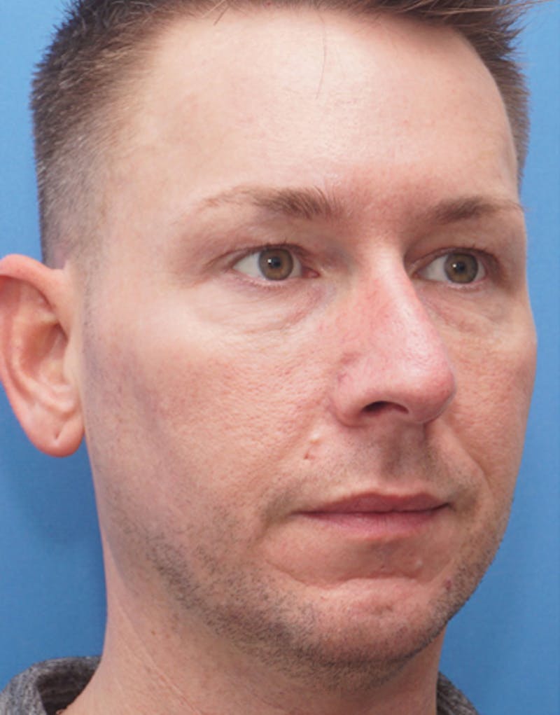 Favorite Male Rhinoplasty Before & After Gallery - Patient 409461 - Image 7