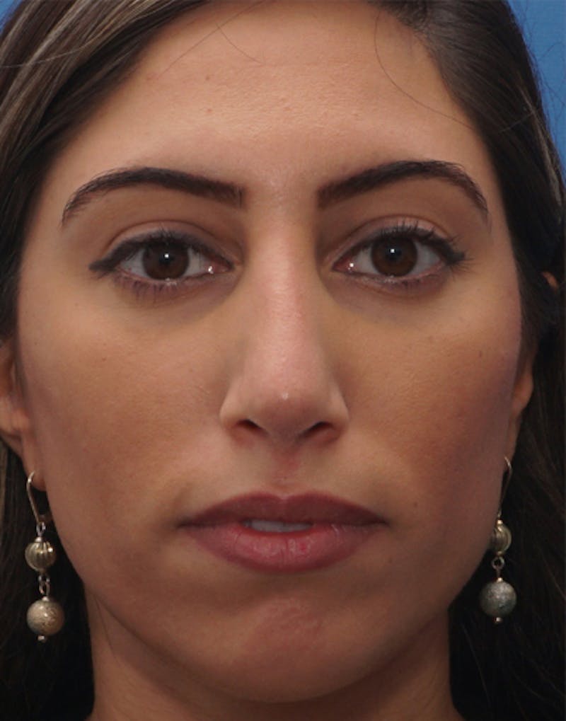 Revision Rhinoplasty Before & After Gallery - Patient 310051 - Image 4