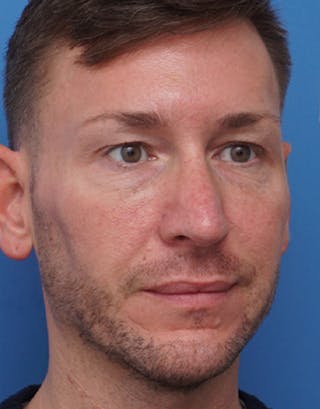 Favorite Male Rhinoplasty Before & After Gallery - Patient 409461 - Image 8