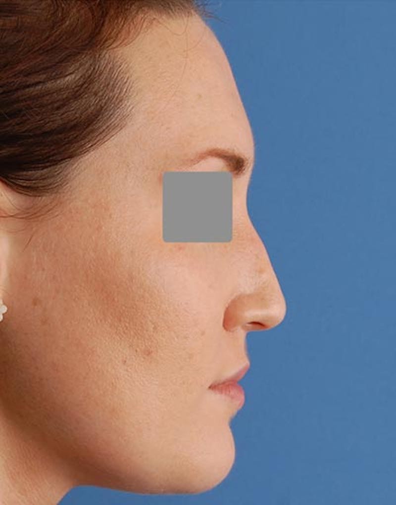 Rhinoplasty Before & After Gallery - Patient 974055 - Image 1