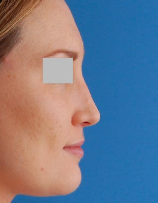 Rhinoplasty Before & After Gallery - Patient 262217 - Image 2