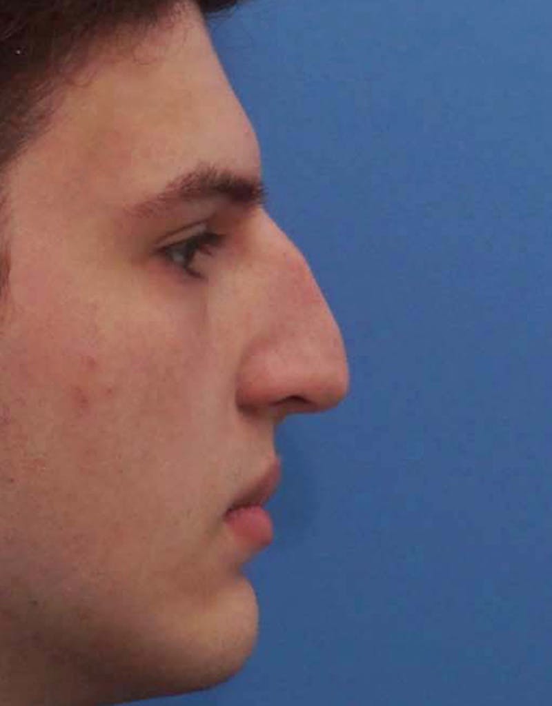 Patient FgsJa8ppQXyJEoigLULjbg - Male Rhinoplasty Before & After Photos