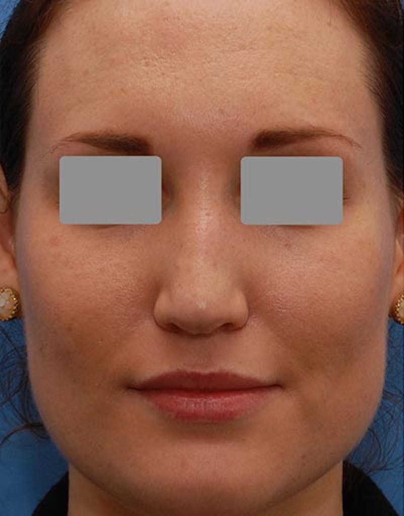 Rhinoplasty  Before & After Gallery - Patient 262217 - Image 3