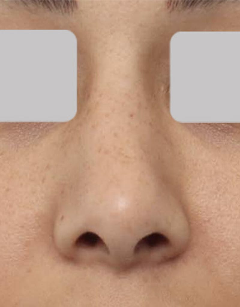 Patient Xm4KhFxAQOS3obcqFbdGZw - Revision Rhinoplasty Before & After Photos